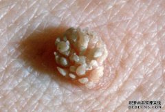 如果肿瘤没有愈合，人们起初就会感到疲倦。这