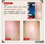 如何修复或维持红细胞表面的表皮？