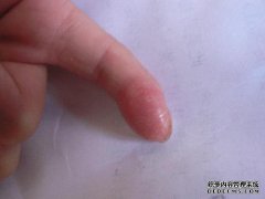 如果我的脚干裂了怎么办？
