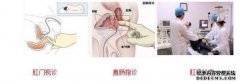他可以用氧气治疗肛周脓肿吗？
