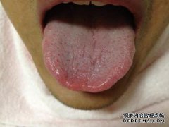你为什么吃瓜？瓜舌我该怎么办？