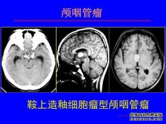 下颌成纤维细胞瘤需要多长时间才能接受植骨？