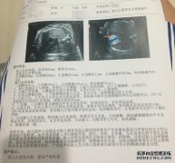 前列腺癌很强吗？