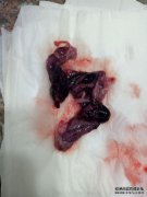 60天自动流产，怀孕囊和比怀孕囊更大的肉，是双