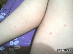 吃虾后，鼻子上有一个小红点，发痒，没有感觉