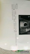 如果我有结囊肿会怎样？